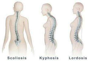 Kyphosis Lordosis Scoliosis