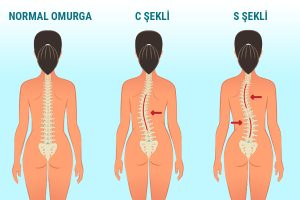 Resim_1._Normal_Omurga_-_S_ve_C_seklini_aldigi_skolyoz
